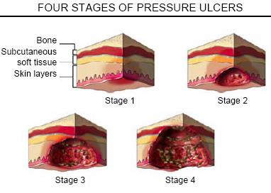 8 출처 : Healthwise 6. Arterial Ulcer(Ischemic Ulcer) A.
