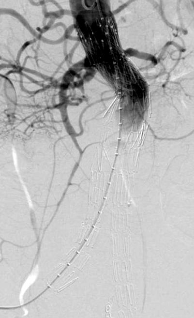 컴퓨터 단층촬 영 결과 직경 77 mm 신장동맥하 복부대동맥류로 대동맥 목은 길이 54 mm, 직경 24 mm,