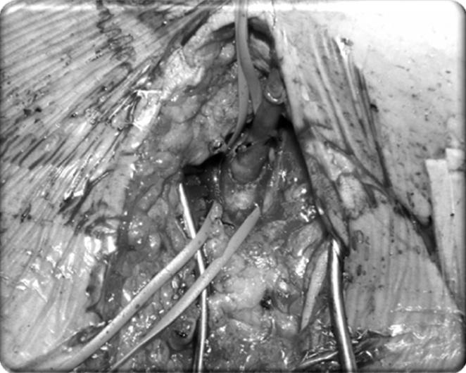 70 Korean J Vasc Endovasc Surg Vol. 27, No. 2, 2011 Fig. 3. Femoro-femoral bypass with autologus reversed great saphenous vein. 대복재정맥은그대로남아있었다 (Fig. 3).
