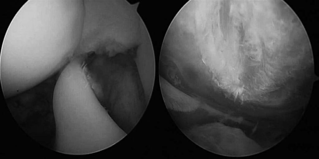남기영 : 견관절일차성유착성관절낭염환자의견봉하관절경소견 Fig. 3. 46-year-old female patient show thick rotator interval () and attrition of coracoacromial ligament (). 유착된견봉하점액낭역시제거하였다.