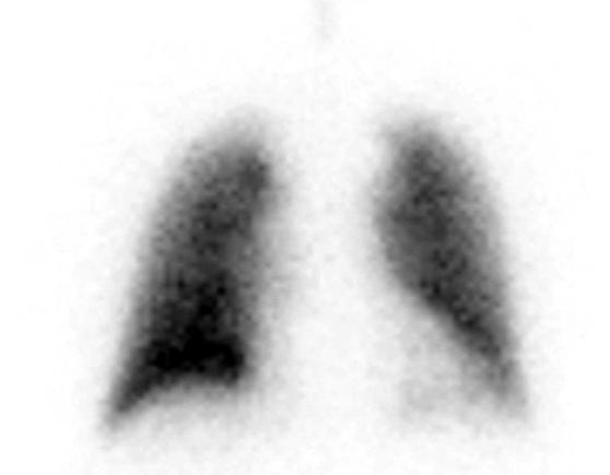 0 mm Hg, bicarbonate 24 mm Hg였다. 영상소견 : 외부병원에서시행한단순흉부방사선사진에서는특별한이상소견을관찰할수없었다 (Figure 1). 폐동맥CTA에서도폐동맥색전의증거를찾을수없었으며, 폐실질내의특이소견도보이지않았다 (Figure 2). 폐환기 / 관류스캔상에서는양측폐의다발성관류결손을확인할수있었다 (Figure 3).
