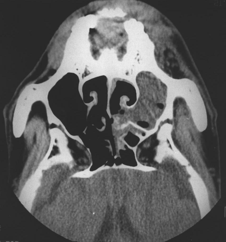 전은주 외 Fig. 2. Photomicrograph of necrotic mucosa of maxillary sinus shows mucoraceous zygomycetes with characteristic broad, pleomorphic, irregular nonparallel contours (hematoxylin-eosin stain, 400).