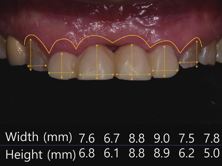 정해용 최유성 마모를동반한비심미적인상, 하악전치부비율을가진환자에서체계적인진단및치료과정을통해기능및심미성이개선된보철수복증례 Fig. 3. nalysis of teeth width and length.