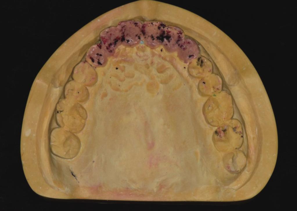 mandibular wax-up model, () Wax-up on the palatal surface of the