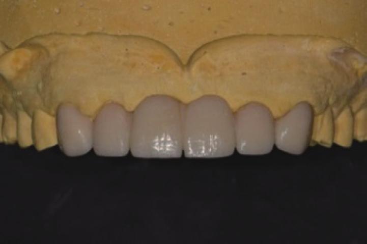 11), 치아 형성 후 미 리 제작한 임시 수복물을 구강 내에서 조정 후 장착하였다 (Fig. 12, Fig. 12).