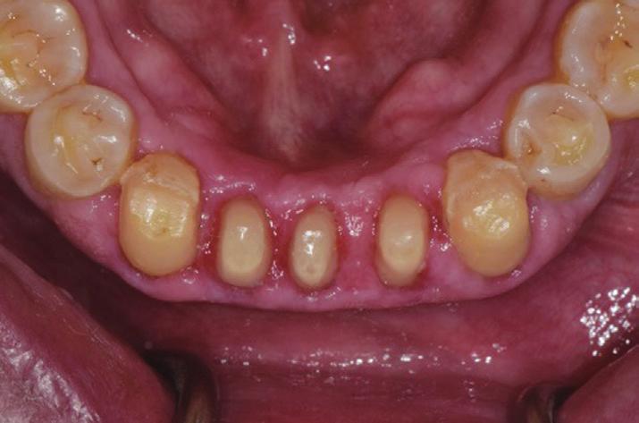 maxillary anterior teeth,  mandibular
