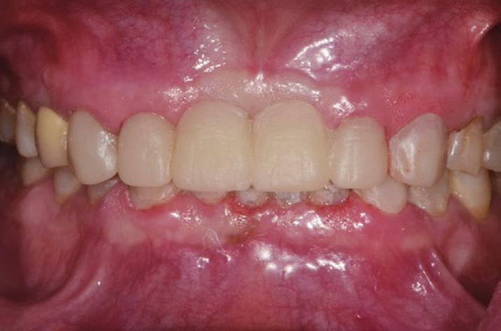 Teeth preparation and provisional
