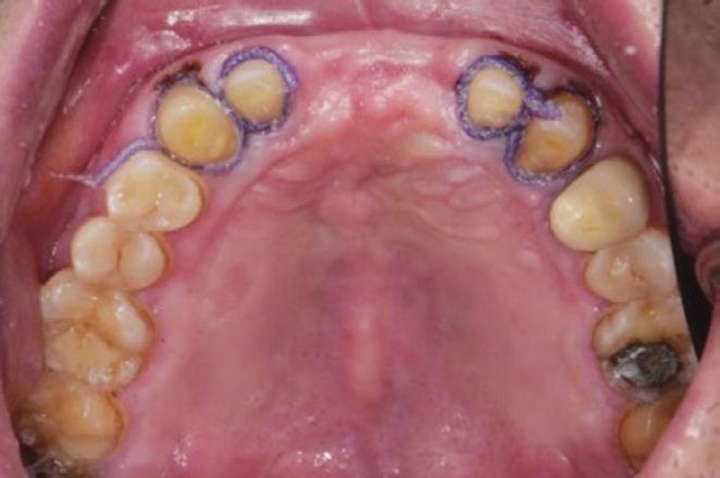 () Frontal view after teeth preparation, ()