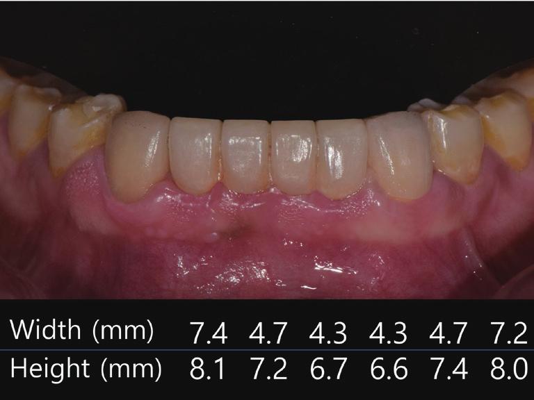 () Frontal view of maxillary anterior teeth, () Frontal view of mandibular anterior teeth. D E F Fig.