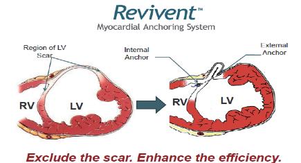 Revivent Myocardial Anchoring System Revivent Myocardial Anchoring System Region of LV Scar Internal Anchor External Anchor Internal and external anchors