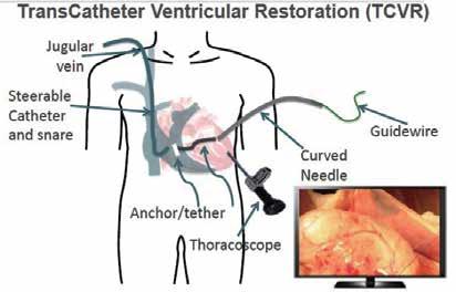 CARDIOVASCULAR UPDATE Jugular vein Steerable catheter and snare TransCatheter Ventricular Restoration (TCVR) Curved needle Guide wire Anchor/tether