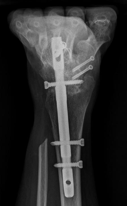 Both anteroposterior and lateral radiographs show the successful fusion trabeculae crossing the fusion site. A B C Figure 1.