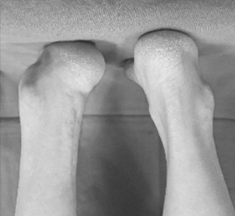 9 (valgus) Hindfoot alignment ( ) 12.9±9.4 1.7±3.5 (valgus) Visual analogue scale 7.6 2.9 AOFAS score 35.4 70.6 Values are presented as mean±standard deviation or mean only. ***p<0.001.