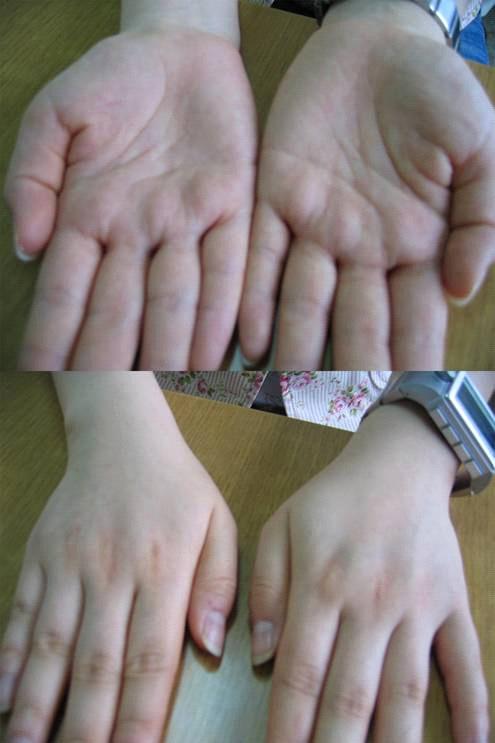 Figure 1. Prominent atrophy of the thenar muscle (upper) and mild atrophy of the first dorsal interossei muscle (lower) are shown in her right hand. 다.