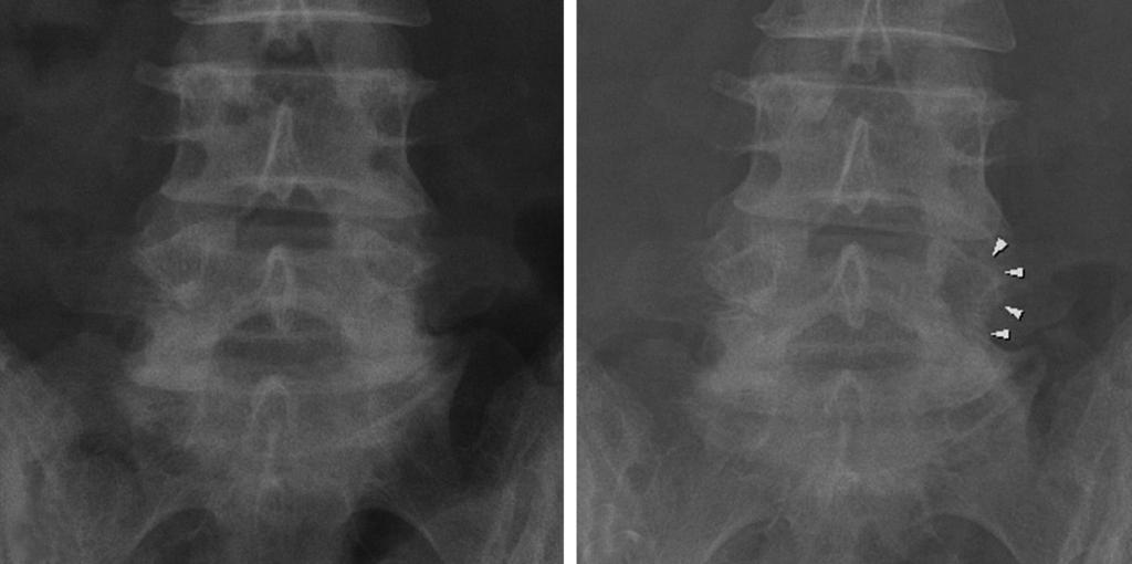 (A) Preoperative anteroposterior plain radiograph is obtained in a 73-year-old man with a left-sided L5 radiculopathy and an L5-S1 extraforaminal stenosis.