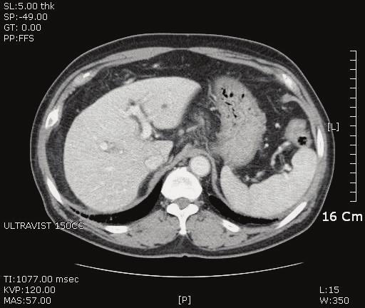 A Case of Reactivation of Hepatitis B and Fulminant Hepatitis which developed 3 months following Chemotherapy
