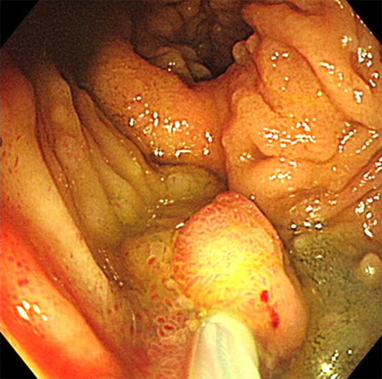 강정민외 7 인. 가족샘종폴립증수술후회장낭에발생한샘종폴립 51 Fig. 2. Case 2. (A) Endoscopic findings of ileal pouch after ileal pouch-anal anastomosis. An about 1 cm sized polypoid adenoma was noted on the ileal pouch.
