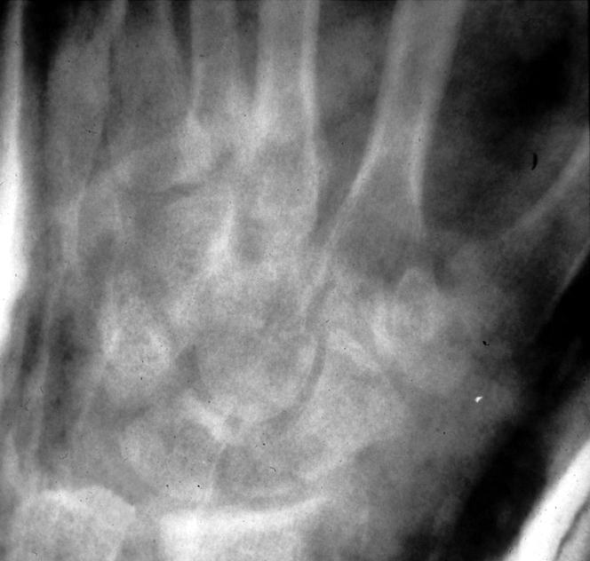 Radiograph shows an almost dislocated trapeziometacarpal joint.
