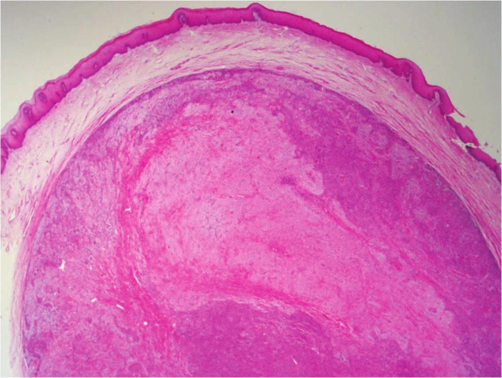 671 Spindle Cell Epithelioma of the Vagina 으며 유사분열도 관찰되지 않았고, 기질양 세포 영역에서 연골 및 골성분 또한 관찰되지 않았다. Fig. 1.