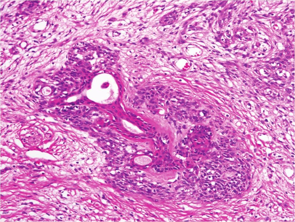 그리고 종양의 국소절제술 시행 후 12개월 경과된 현 재 재발이나 전이의 증거는 보이지 않고 있다. A B C D Fig. 2. Histological findings of a spindle cell epithelioma of the vagina.