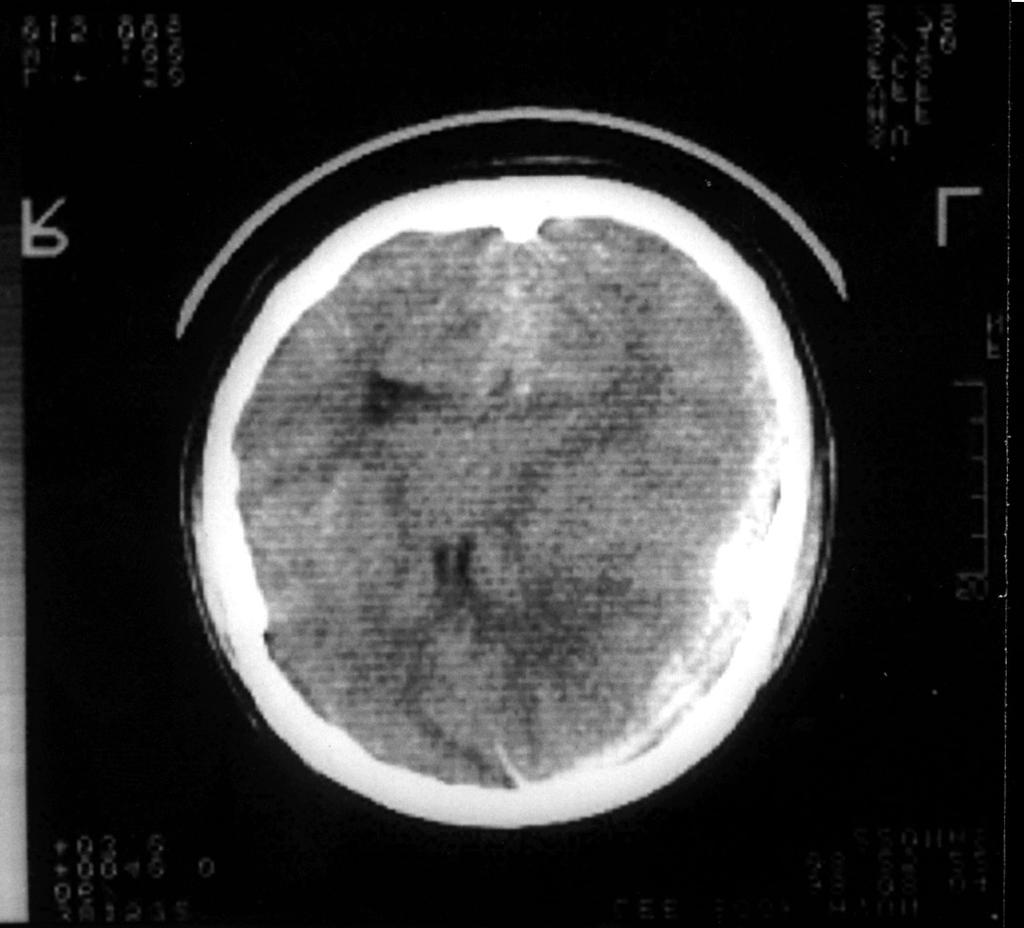 Fig. 2. Case 1. Pre-op brain CT scan shows SDH and severe midline shifting(). Post-op brain CT scan shows intact brain and replaced bone flap().