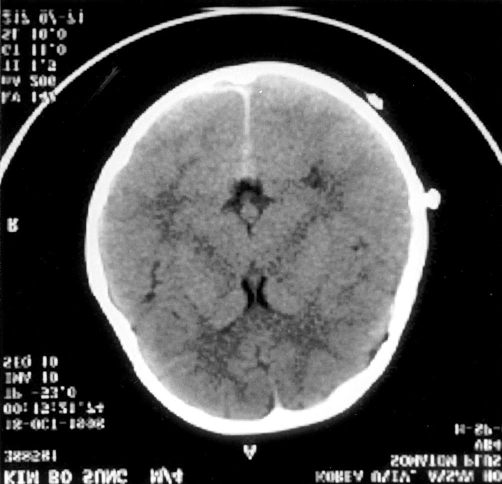 급성 경막하 혈종에서 응급 두개골 천공의 위치 Fig. 3. Case 2. Postop CT scan shows mild brain swelling with no residual hematoma().