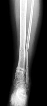 (A) Preoperative anteroposterior radiograph shows Salter-Harris type II physeal injury of distal tibia and fibular fracture.