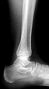 674 김정렬ㆍ송광훈 Fig. 2. A 7 year-year-old boy sustained physeal injuries of the left ankle.