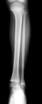 (B) Postoperative radiograph after closed reduction and percutaneous pinning for distal tibia and closed reduction for distal fibular physeal fracture.