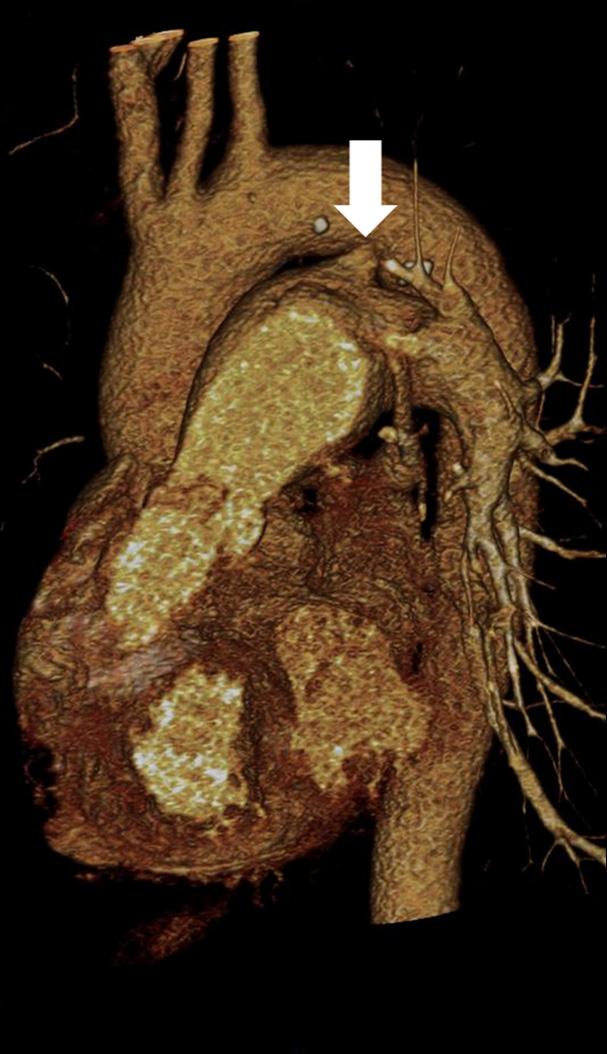 A sagittal view of the CT scan showed a connection between the left pulmonary artery and the distal aortic arch (black arrow). Asc. Ao.