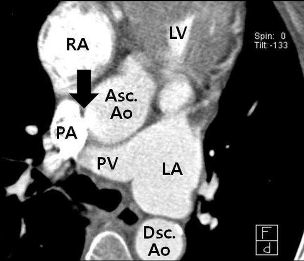 A CT scan and three-dimensional reconstruction of the aorta suggested a patent ductus arteriosus (white arrow) (C). 전이동반되었으며폐동맥판협착으로인해정확한폐동맥압측정은어려웠다. 좌심실구혈률은 55% 로좌심실수축기능은정상이었다.