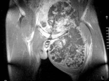 24 조현민ㆍ이승구ㆍ강용구외 4 인 Figure 5. MRI shows a large inhomogeneous, irregularly marginated mass with maximum 4 cm-thick cartilage cap of decreased T1 and increased T2 signal intensities. Figure 6.
