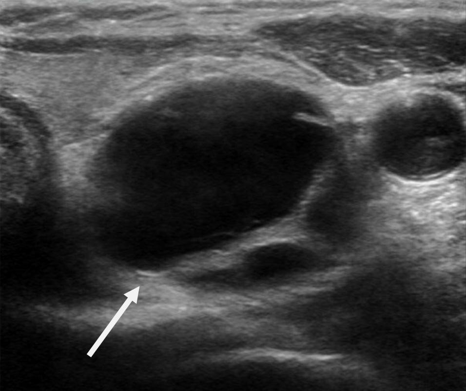 - 한민귀외 5 인. 부갑상선선종의초음파적진단 - A B Figure 2. A case of left lower parathyroid adenoma with (A) atypical ultrasonography image and (B) negative 99m Tc-sestamibi scan.