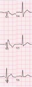 ORIGINAL ARTICLE A B C Figure 2. Newly developed J wave during therapeutic hypothermia in patient with Brugada syndrome. (A) Brugada pattern ECG. No J wave in lateral leads (V4-6).