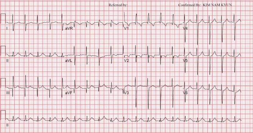 narrow QRS tachycardia with short RP interval.