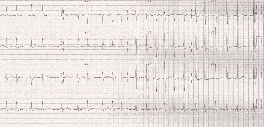 ECG & EP CASES Figure 1. The initial electrocardiogram shows atrial fibrillation. ST segment depression is noted in the anterolateral leads. A B Figure 2.