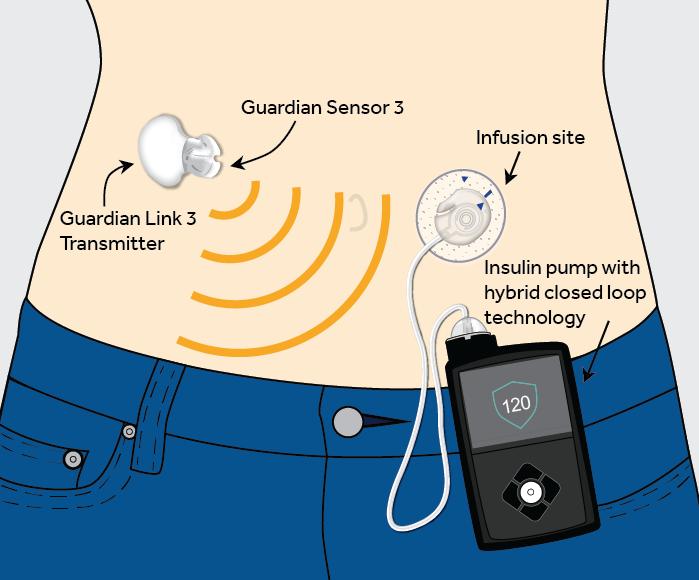 Medtronic 펌프와연결해 인공췌장으로사용됨 Guardian Sensor 3(Medtronic): Medtronic