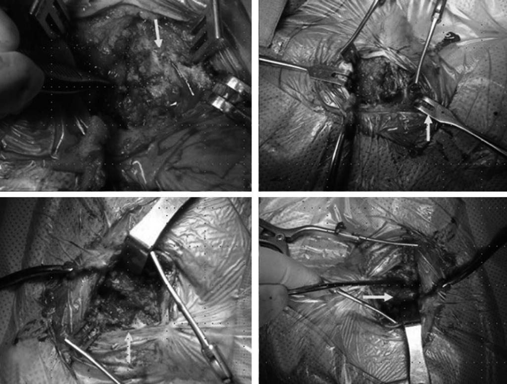 김영율 : 흉쇄관절에발생한화농성관절염과결핵성관절염의수술적치료 - 증례보고 - A B C D Fig. 3. Surgical dissection was performed in the the sterno-clavicular joint tuberculosis. Fig. 4.