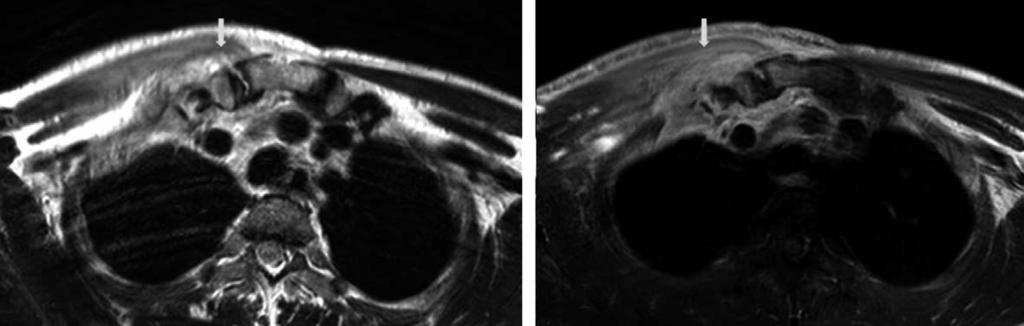 김영율 : 흉쇄관절에발생한화농성관절염과결핵성관절염의수술적치료 - 증례보고 - Fig. 7. Preoperative axial T2 weighted MRI (A) shows tubular high T2 signal intensity lesion with soft tissue extension in the right SC joint.