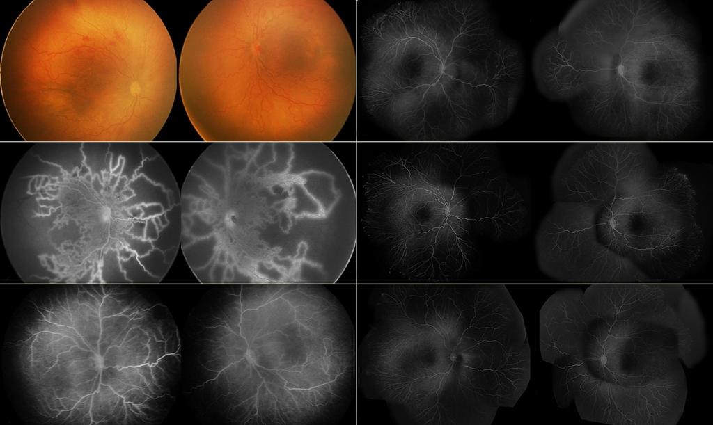 - 검안및콘택트렌즈학회지 2018 년제 17 권제 4 호 - A D B E C F Figure 2. Bilateral fundus photographs and montage fluorescein angiography (FA) of aggressive posterior retinopathy of prematurity.
