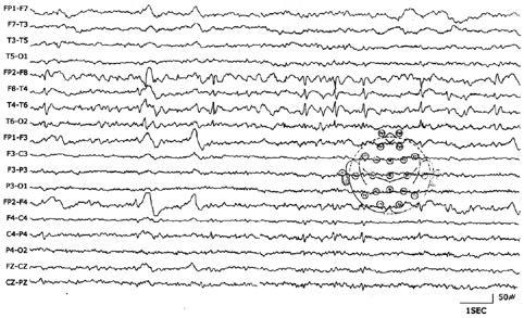 Figure 2. Interictal EEG recording in III-8 case with poorly controlled seizure.