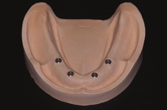 guide pins before pickup impression. Fig. 2. A dental stone working cast made from a pickup impression of the superstructure. Fig. 3.