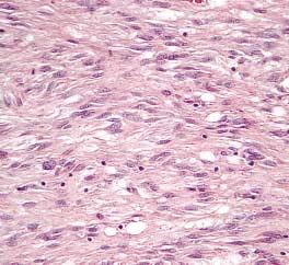 In this case the tumor cells reveal epithelioid features.