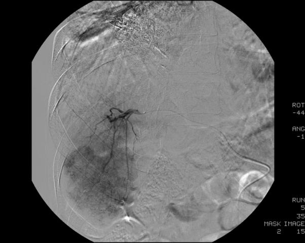 CTHA and CTAP showing expansive thrombosis in the right portal vein (arrow).