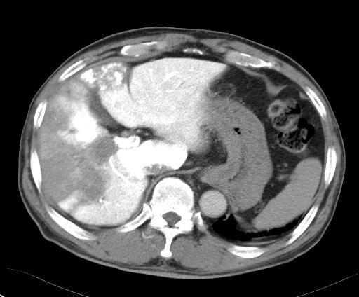 These findings suggest invasion of the hepatocellular carcinoma into the portal vein.