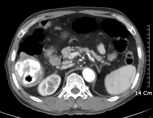 After percutaneous ethanol injection therapy under CT guidance (arrow) (C), the extent of the tumor thrombosis in the