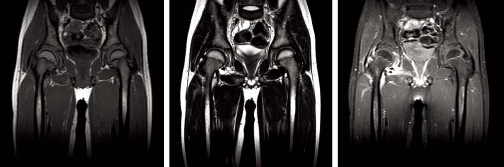 Soo-Sung Park et al.: MRI in Suspected Acute Septic Arthritis of the Hip Joint in Children A B C Fig. 1. 9-year-old boy with acute septic arthritis in Rt hip joint.