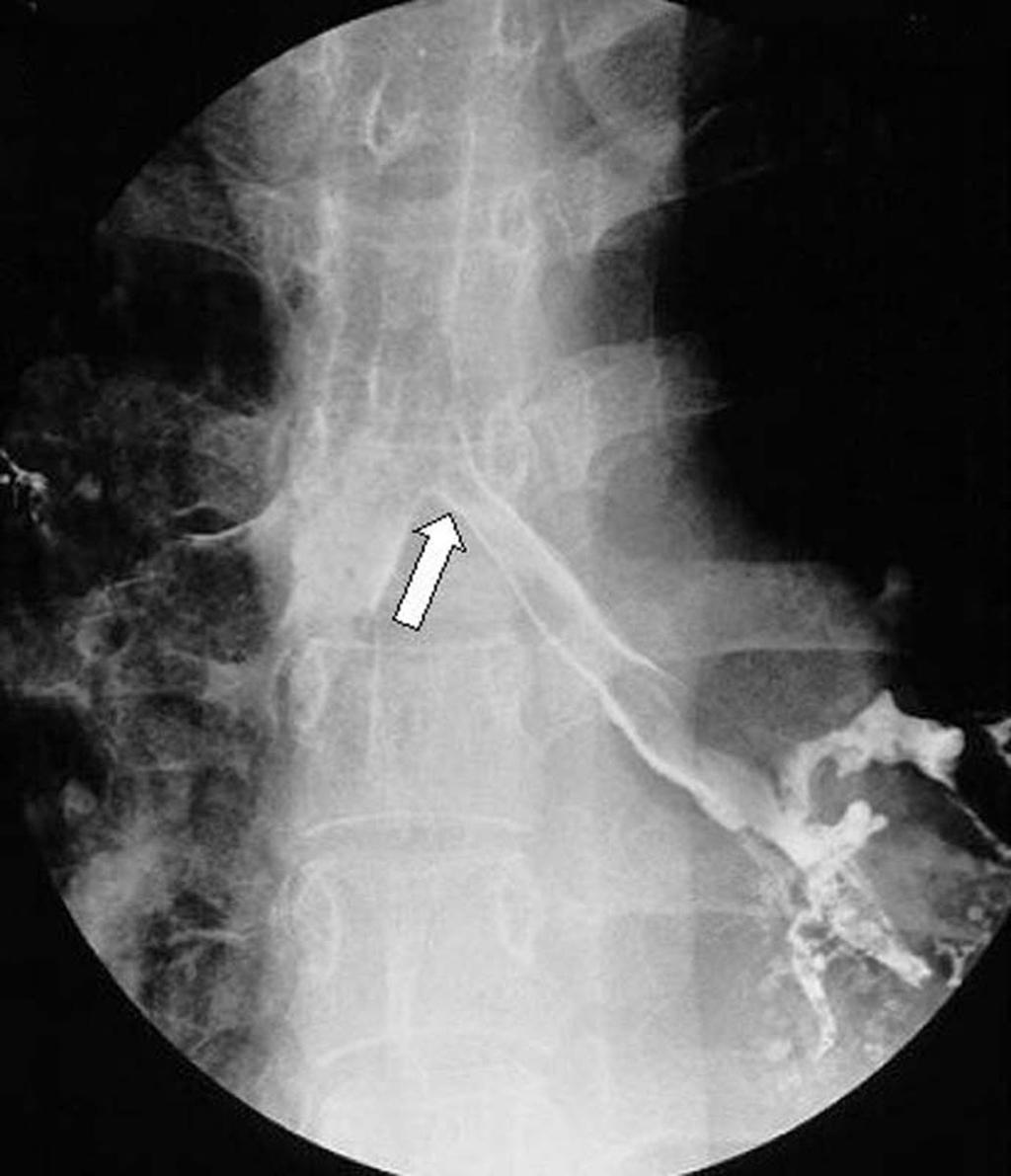 Indications for Tracheobronchial Stent Placement Malignant enign ronchogenic carcinoma Intraluminal lesion Extraluminal lesion Primary airway tumor Squamous cell carcinoma denoid cystic
