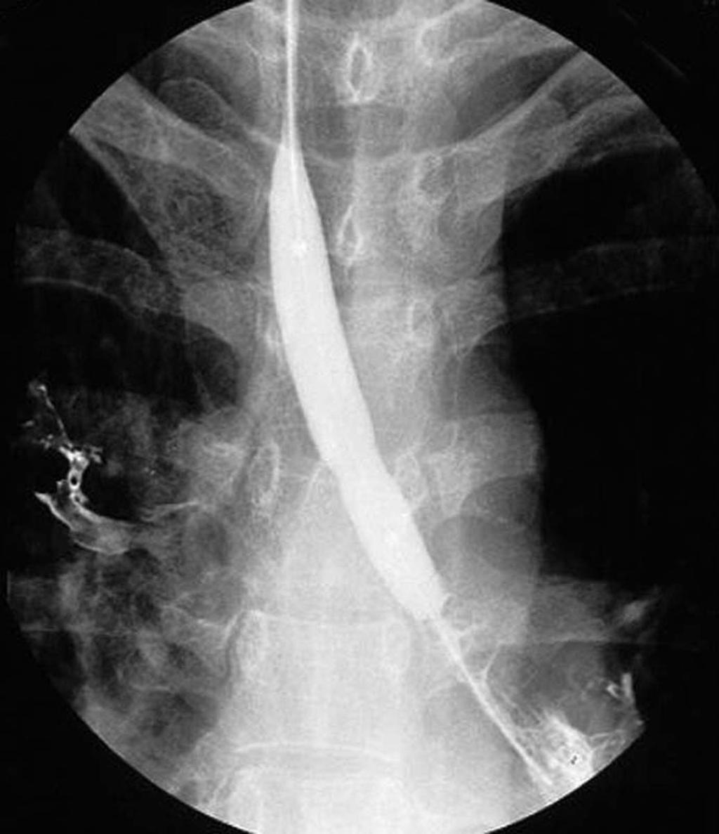 Histoplasmosis Post-intubation stenosis nastomotic Lung transplantation Sleeve resection Tracheobronchomalacia ongenital tracheal stenosis ompression by esophageal stent Fig. 1.