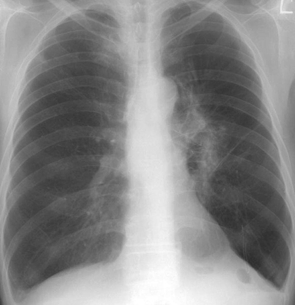 chest radiograph () and 3-T image () show total collapse of the left lung and abrupt cut-off of the left bronchus.